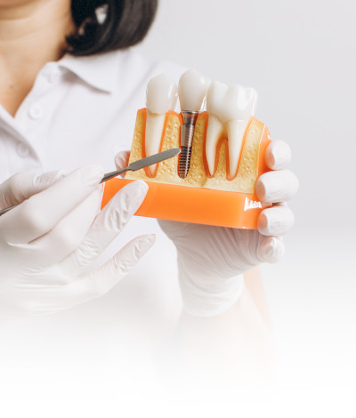 Implant implants implantologie dentaire salon de Provence
